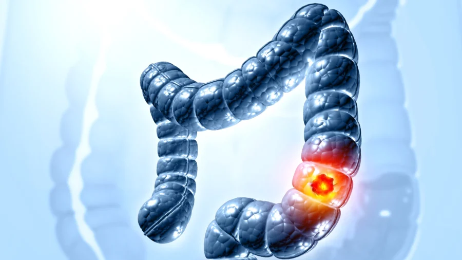 Colorectal Cancer Now Deadliest Cancer for Young Americans