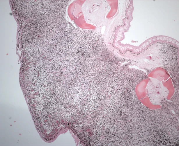Photomicrograph showing a melanoma on a fin of a brown bullhead fish. In the upper right-hand part is normal skin (epidermis). (U.S. Geological Survey)