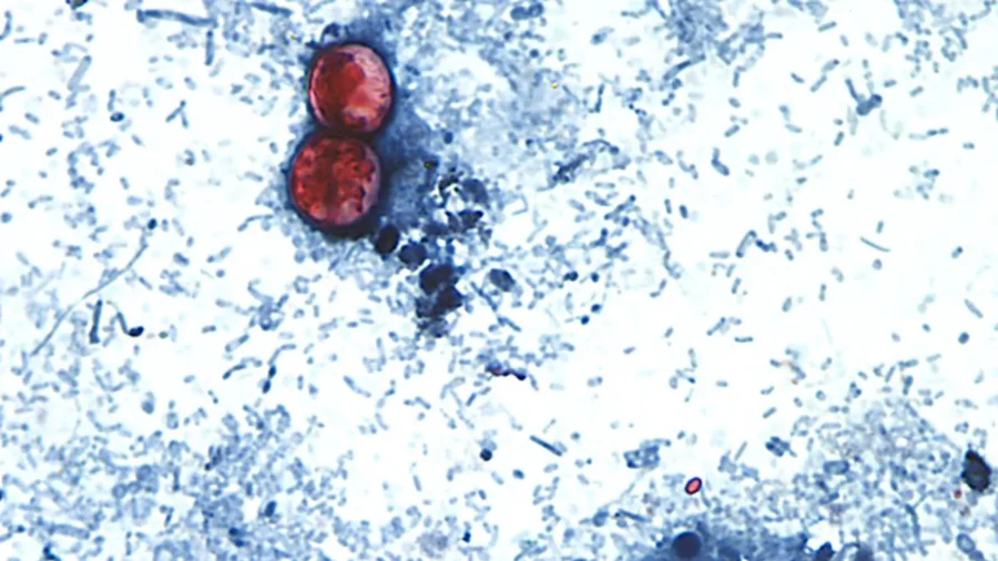 Disease Caused by Cyclospora Parasite Now in 45 States: CDC
