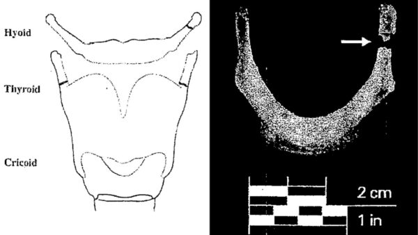 A diagram from Jeffrey Epstein's autopsy that shows one of the fractures he sustained. (New York City Medical Examiner's Office)