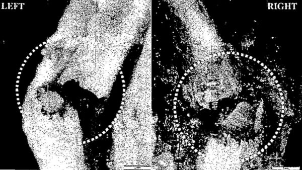 Another medical examiner's photo shows the fractures. (New York City Medical Examiner's Office)