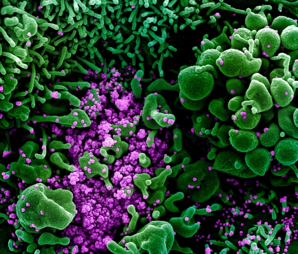 Colorized scanning electron micrograph of cell (green) heavily infected with coronavirus particles (purple), commonly known as SARS-CoV-2 or novel CCP virus, isolated from a patient sample, photo published on March 16, 2020. (NIAID)